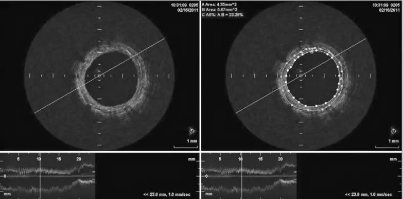 Figura 1 - No painel à esquerda, imagens representativas da tomografia de coerência óptica com corte transversal e reconstituição longitudinal de stent Inspiron TM ; no painel à direita, quantificação da área do lúmen (4,35 mm 2 ), da área do stent (5,67 m