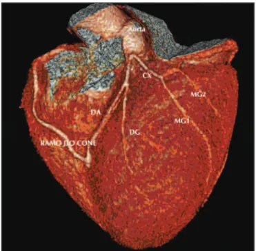 Figura 3 - Coração exposto (vista anterior), evidenciando-se as artérias descendente anterior e primeiro ramo diagonal