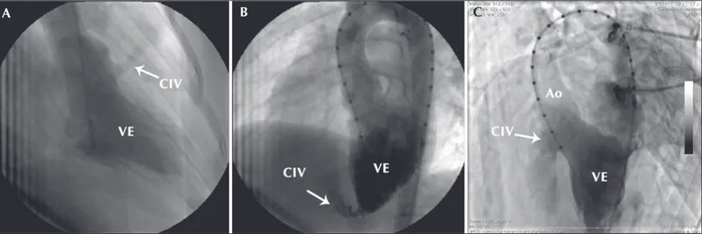 Figura 2 - Exemplos de ventriculografia esquerda para delinear os defeitos. Em A, comunicação interventricular muscular infundibular, tipicamente mais bem delineada em oblíqua anterior direita