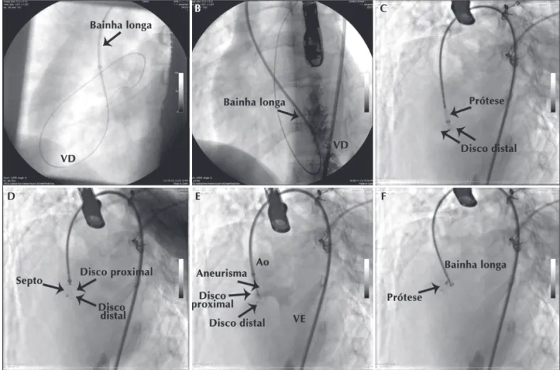 Figura 3 - Etapas do implante pela técnica retrógrada. Em A, guia no ramo esquerdo pulmonar depois de cruzada a comunicação interventricular pelo ventrículo esquerdo, com a bainha longa sendo introduzida sobre a guia