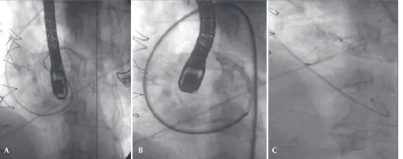 Figura 5 - Em A, ecocardiografia transesofágica, demonstrando bom posicionamento da prótese Amplatzer TM  e trombose parcial do pseudoaneurisma.