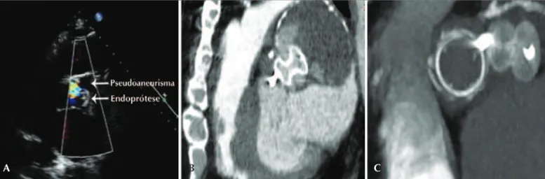 Figura 6 - Em A, ecocardiografia transtorácica, demonstrando bom posicionamento da prótese Amplatzer TM , trombose parcial do pseudoaneurisma, e fluxo periprótese