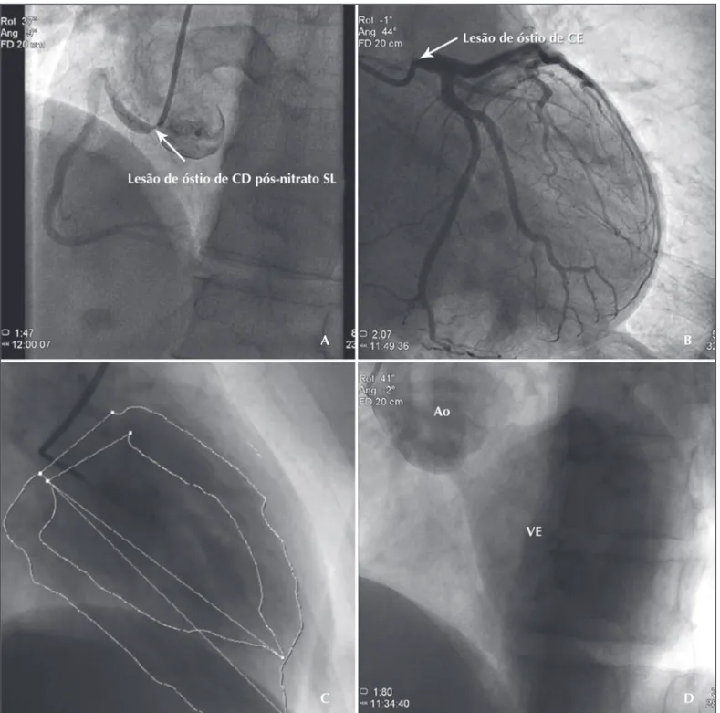 Figura - Coronariografia demonstrando lesão significativa de óstio de artéria coronária direita (A) e óstio de tronco da coronária esquerda (B), ventriculografia demonstrando função ventricular preservada (C), e aortografia demonstrando insuficiência aórti