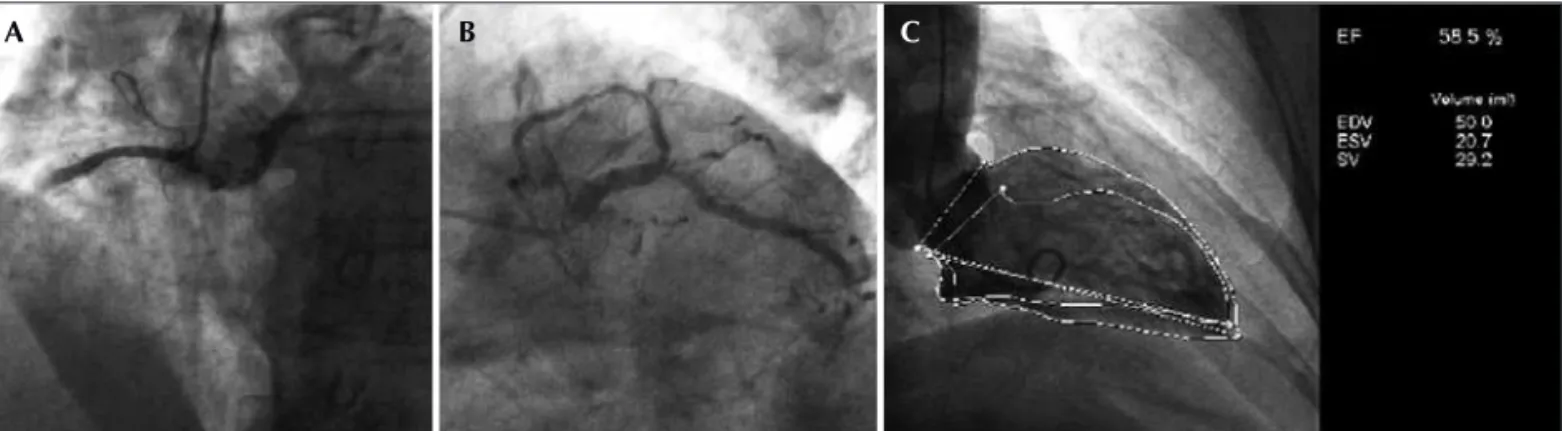 Figura 1 - Cateterismo cardíaco realizado em agosto de 2010, evidenciando doença coronária grave de 3 vasos e função ventricular esquerda globalmente conservada