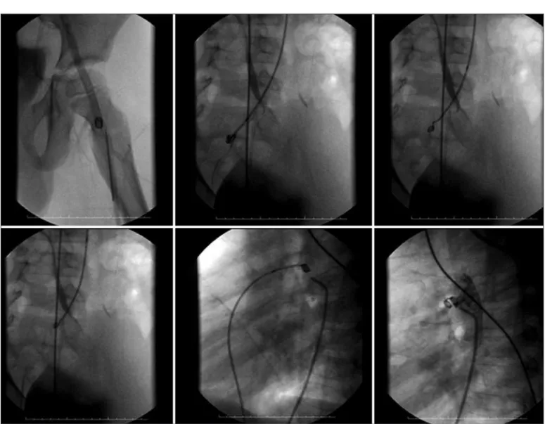 Figura 4 - Painel superior: à esquerda, em PA, imagem da mola embolizada na artéria femoral esquerda; no centro e à direita, em oblíqua anterior direita, a mola encontra-se na artéria ilíaca comum, sendo resgatada através do sistema liberador