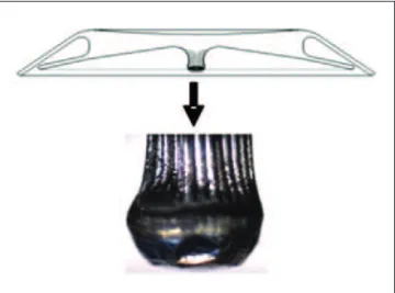 Figura 5 - Ecocardiografia transesofágica multiplanar (52 graus) em corte transversal pouco acima do nível da valva aórtica,  demons-trando ampla comunicação interatrial com borda anterior deficiente.