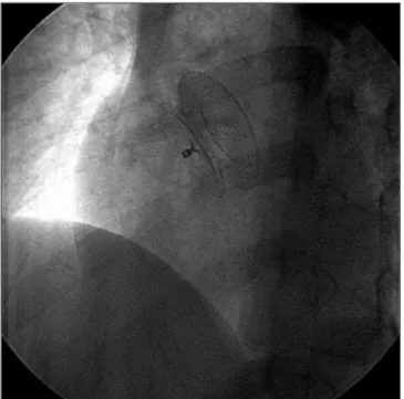 Figura 11 - Ecocardiograma transtorácico 3D em tempo real antes da alta hospitalar, demonstrando prótese vista do átrio direito em ótima posição e com baixo perfil.