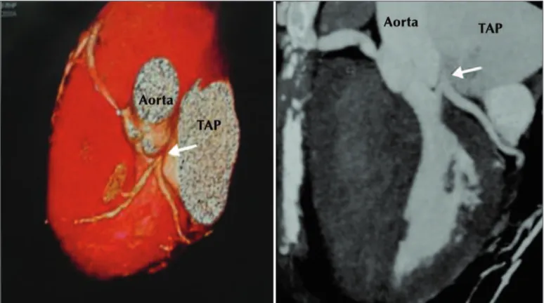 Figura 1 - Em A, injeção de contraste na aorta com ausência da visualização do tronco de coronária esquerda (seta)