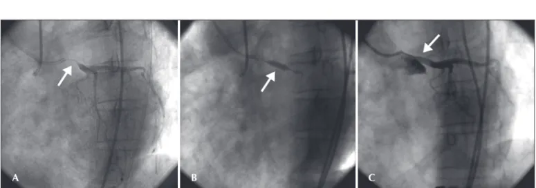 Figura 3 - Em A, tronco de coronária esquerda em oblíqua anterior esquerda com fio guia passado, antes da dilatação (seta)