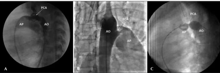 Figura 2 - Demonstração do canal. Em A, aortografia lateral demonstrando canal tipo C (caso 3)