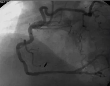 Figura 2 - Resultado final da angioplastia primária com implante de stent em coronária direita.