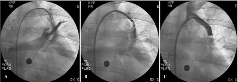 Figura 7 - Anastomose cirúrgica da artéria subclávia esquerda e veia pulmonar superior esquerda