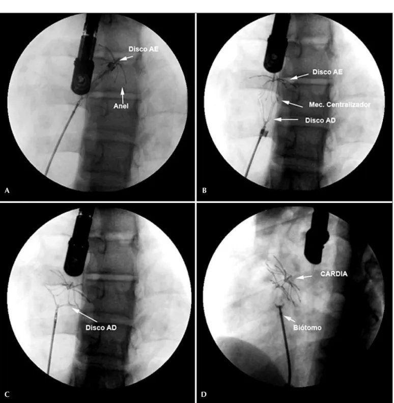 Figura 4  - Imagens angiográficas do implante. A: Disco esquerdo imediatamente após sua exteriorização no corpo do átrio esquerdo