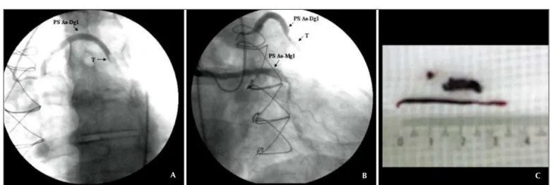 Figura 3  - Angiografia no enxerto coronariano ponte de safena aorta-primeira diagonal (PS Ao-Dg1), evidenciando fluxo coronariano normal através do enxerto (TIMI 3, blush  miocárdico 3).