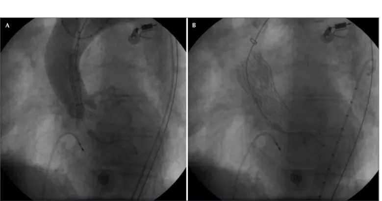 Figura 3  - Sequência angiográfica do implante da prótese aórtica CoreValve. Em A, fase inicial da liberação da prótese sob visualização angiográfica
