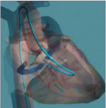 Figura 1 - Cateter-guia de 12,5 F proporciona acesso ao ventrículo esquerdo para todos os outros cateteres do sistema Mitralign.