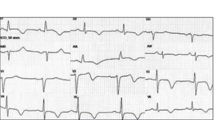 Figura 1 - Eletrocardiograma de 12 derivações evidenciando inver- inver-são da onda T em parede ântero-lateral e lateral alta.