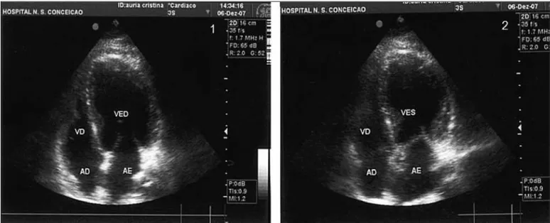 Figura 3 - Ecocardiografia transtorácica: diástole ventricular esquerda (1) e sístole ventricular esquerda com abaulamento apical do ventrículo esquerdo (2).