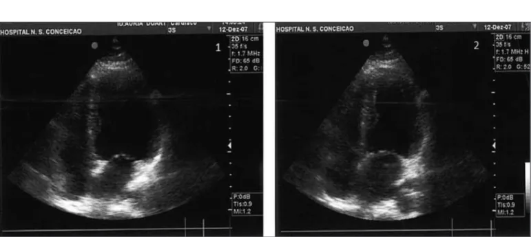 Figura 4 - Ecocardiografia transtorácica: diástole ventricular esquerda (1) e sístole ventricular esquerda com retorno da contratilidade normal (2).