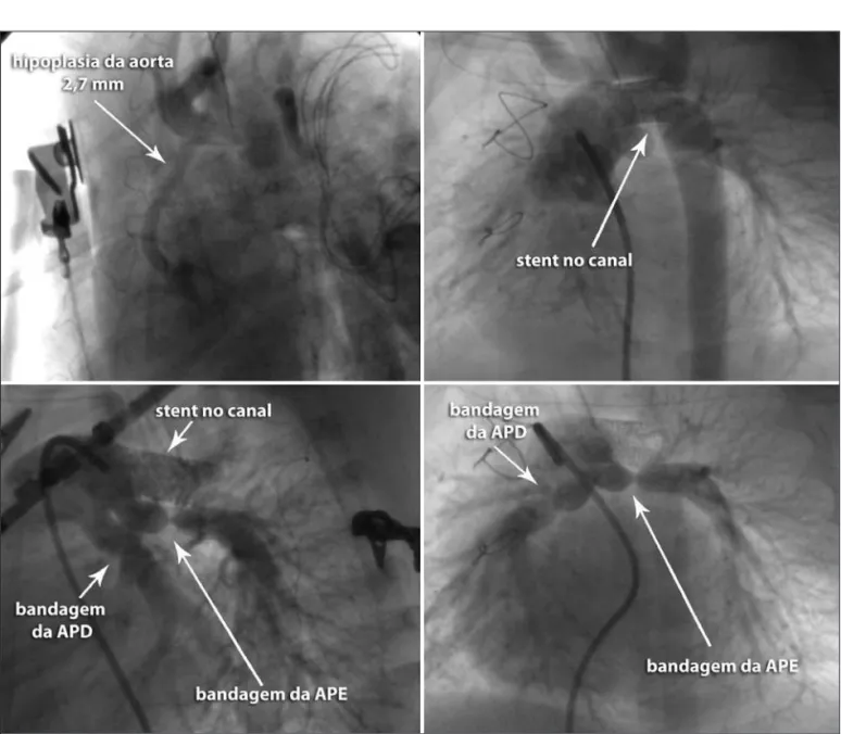 Figura 2  - Angiografia demonstrando aspectos comuns do primeiro estágio do procedimento híbrido na síndrome de hipoplasia do coração esquerdo