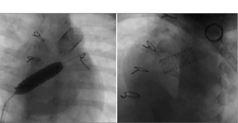 Figura 3  - Angiografia do paciente 6 com comunicação interatrial restritiva submetido a dilatação com balão, seguida de implante de stent.
