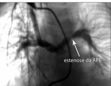 Figura 4  - Angiografia demonstrando estenose da artéria pulmonar esquerda após o segundo estágio (primeiro dia de pós-operatório).