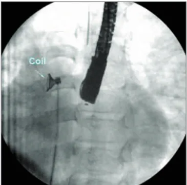 Figura 3 - Angiografia demonstrando a mola configurada na aorta ascendente, pronta para ser trazida para o ventrículo esquerdo através da valva aórtica.