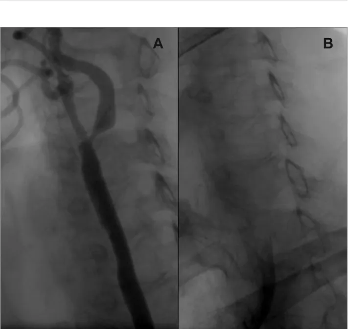 Figura 1 - Angiografia da artéria carótida interna esquerda. A: Durante o procedimento diagnóstico