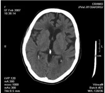 Figura 3 - Tomografia computadorizada de crânio, nas 48 horas após terapia de reperfusão endovascular no acidente vascular cerebral agudo.