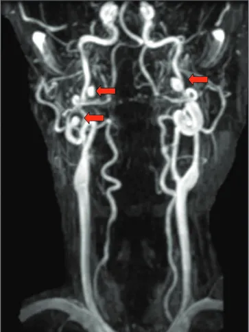 Figura 3 - ARM 3D TOF dos vasos intracranianos demonstrando pseudo-aneurisma (seta) originado da porção distal da artéria carótida interna esquerda, abaixo do nível de entrada no crânio, com a presença de irregularidade proximal (seta entalhada)