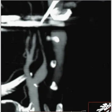 Figura 6 - Angiografia por tomografia computadorizada demonstran- demonstran-do o “sinal demonstran-do barbante”.