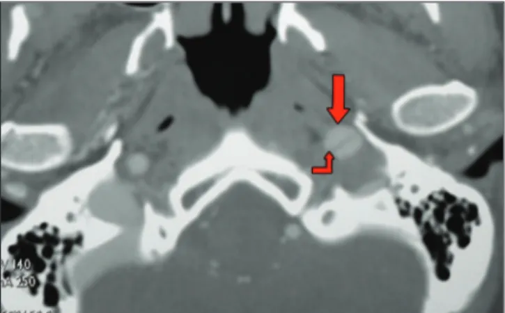 Figura 8 - Angiografia por tomografia computadorizada demonstran- demonstran-do aumento demonstran-do diâmetro da artéria carótida interna esquerda (seta) e a presença de retalho da íntima (seta dobrada).