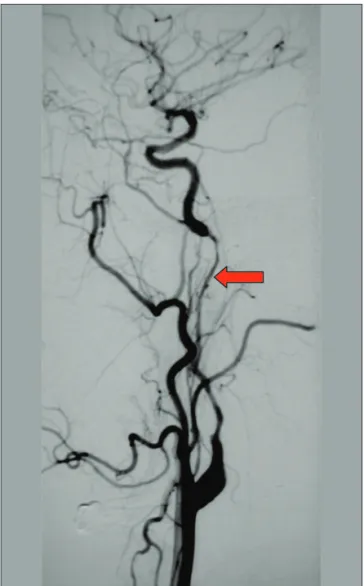 Figura 9 - Angiografia cerebral demonstrando dissecção da artéria carótida interna com padrão estenótico (“sinal do barbante”).