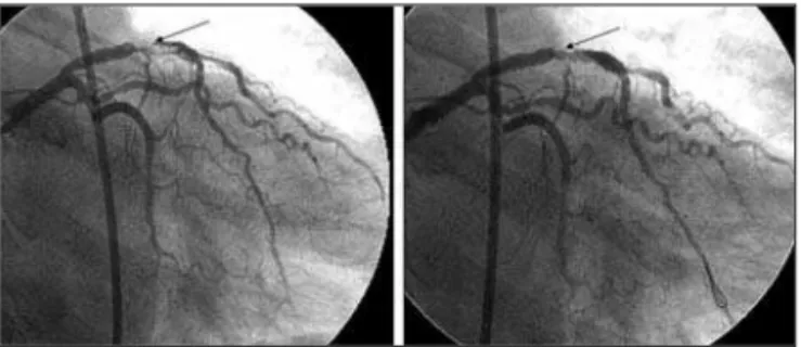 Figura 3 - Artéria interventricular anterior antes e imediatamente após a aspiração de trombo com cateter Pronto ® .