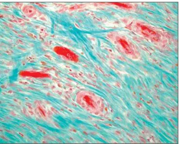 Figura 1 - Coloração em tricromo em modelo canino, mostrando que, após uma injeção intracoronária de células mesenquimais, encontramos uma quantidade significativa de agregados celulares oclusivos em microcirculação 32 .