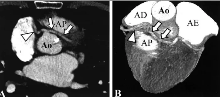 Figura 2 - Origem anômala da artéria coronária esquerda com curso interarterial visualizada por TCAC