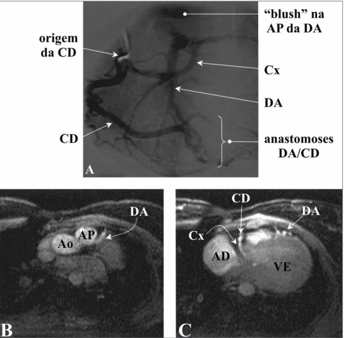 Figura 3 - Atresia do TCE em um paciente portador de valva aórtica bicúspide e ducto arterioso patente