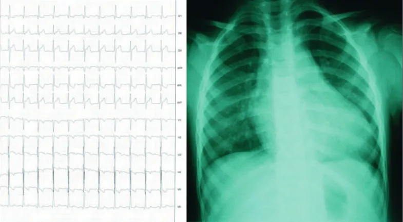 Figura 1 - Eletrocardiograma evidenciando taquicardia sinusal, sobrecarga de câmaras esquerdas e alterações difusas da repolarização ventricular, principalmente nas derivações precordiais