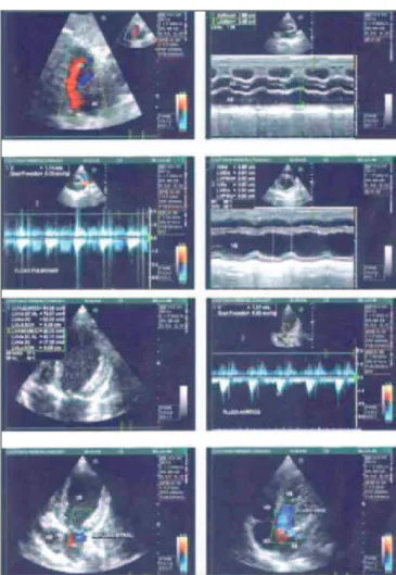 Figura 2 - Presença de refluxo ventrículo esquerdo-átrio esquerdo (VE-AE) moderado, aumento de câmaras esquerdas, hipocinesia de parede ântero-apical, fração de ejeção (FE) de 45%.