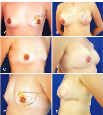 Tabela 6  –  Tabela comparativa das complicações nos trabalhos recentes. Referência n Detalhes da  reconstrução Infecção (%) Hematoma (%) Seroma (%) Necrose (%) Extrusão de pele  (%) Diiculdade  do implante (%) Delação(%) Berry et al