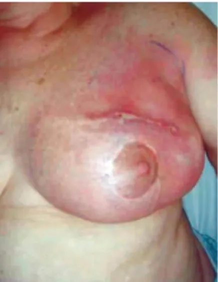 Figura 2 – Distribuição das complicações clínicas de acordo   com a técnica utilizada para reconstrução total de mama