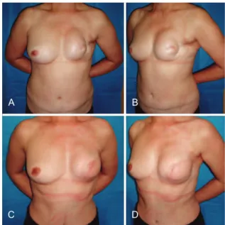 Figura 9 – Em A e B, aspecto pós-operatório de mastectomia  direita com reconstrução com TRAM, que evoluiu com necrose