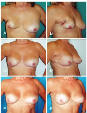 Figura 11 – Em A e B, aspecto pós-operatório de mastectomia  direita com reconstrução com técnica conservadora que evoluiu 