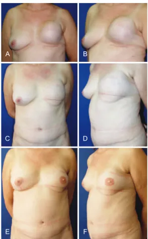 Figura 14 – Em A e B, aspecto 1 ano e 6 meses após mastectomia  esquerda com reconstrução com prótese, apresentando resultado 