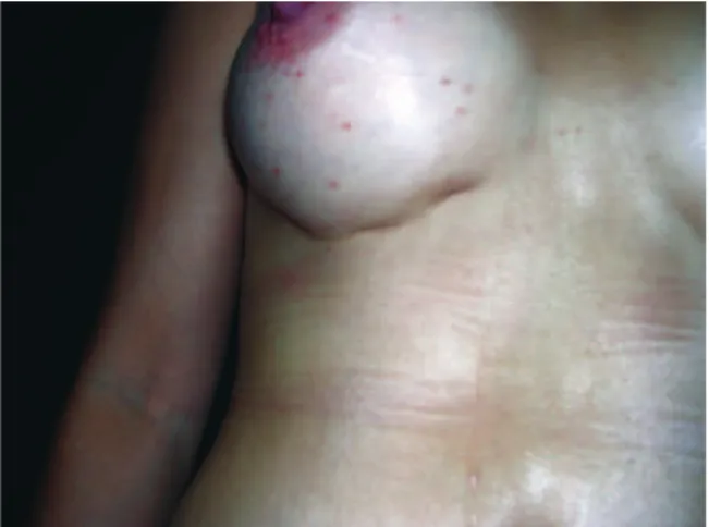 Figura 15 – Aspecto pós-operatório, demonstrando   ixação desigual e muito apertada do sulco mamário.