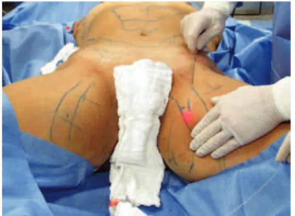 Figura 1 – Transoperatório do estímulo de retração cutânea,   skin tightening, com a extremidade da cânula do laser  