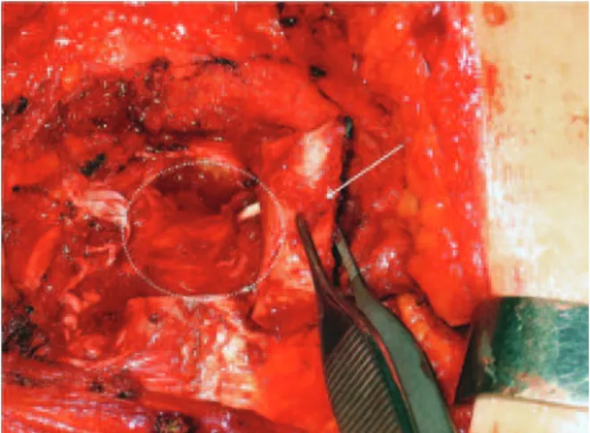 Figura 2 – Afastadores expondo a axila. Dissecção dos vasos  perfurantes da artéria mamária interna (seta branca)