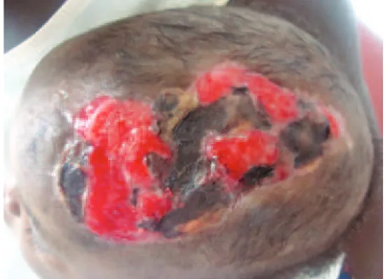 Figura 3 – Tecido de granulação na região da lesão,   10 dias após a realização das microperfurações.