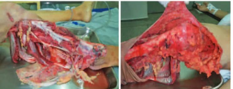 Figura 3 – Aspecto pós-operatório 12 meses após procedimento  cirúrgico com emprego de retalhos musculares e enxerto de pele.