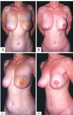 Figura 9  – Paciente de 36 anos de idade, mastectomizada no  lado direito há dois anos, mediante via de acesso por incisão  transversal, com preservação parcial do músculo peitoral na axila